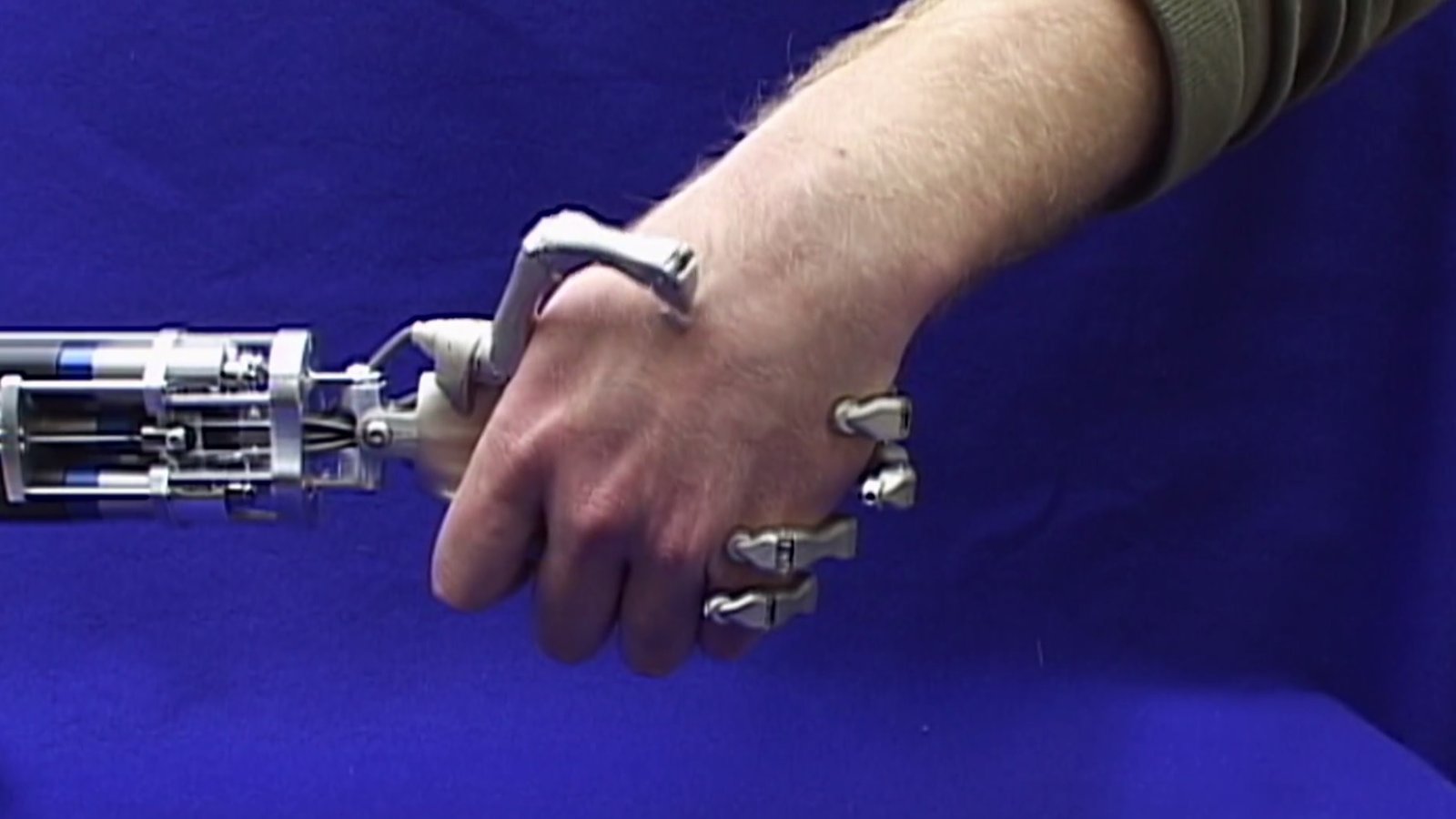 Out on a Limb - The Transformative Impact of Prosthetics Technology